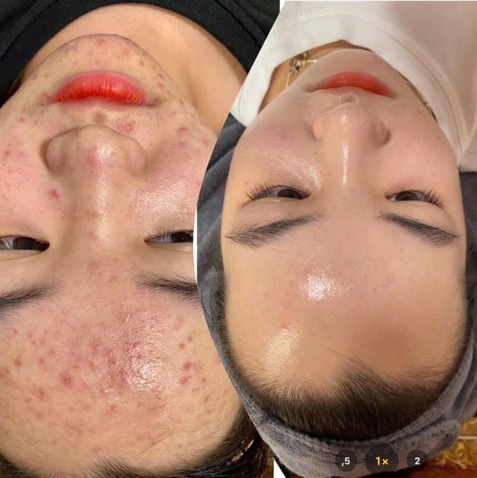 Điều trị mụn PRP