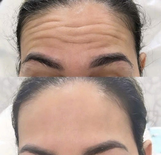 Xóa nếp nhăn (động và tĩnh)