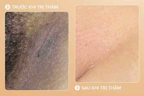 Khử thâm