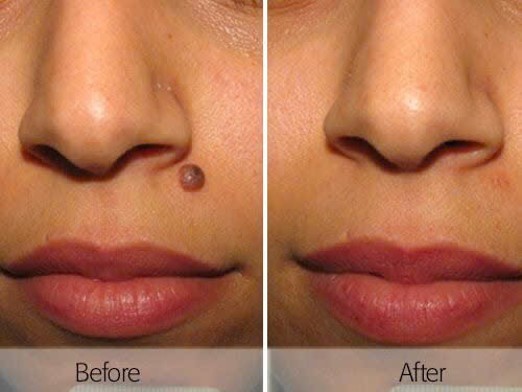 Điều trị sẹo, mụn thịt, mụn ruồi