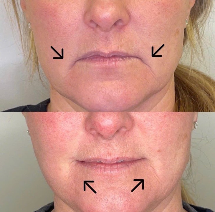 Bắp năm điểm nâng cơ mặt