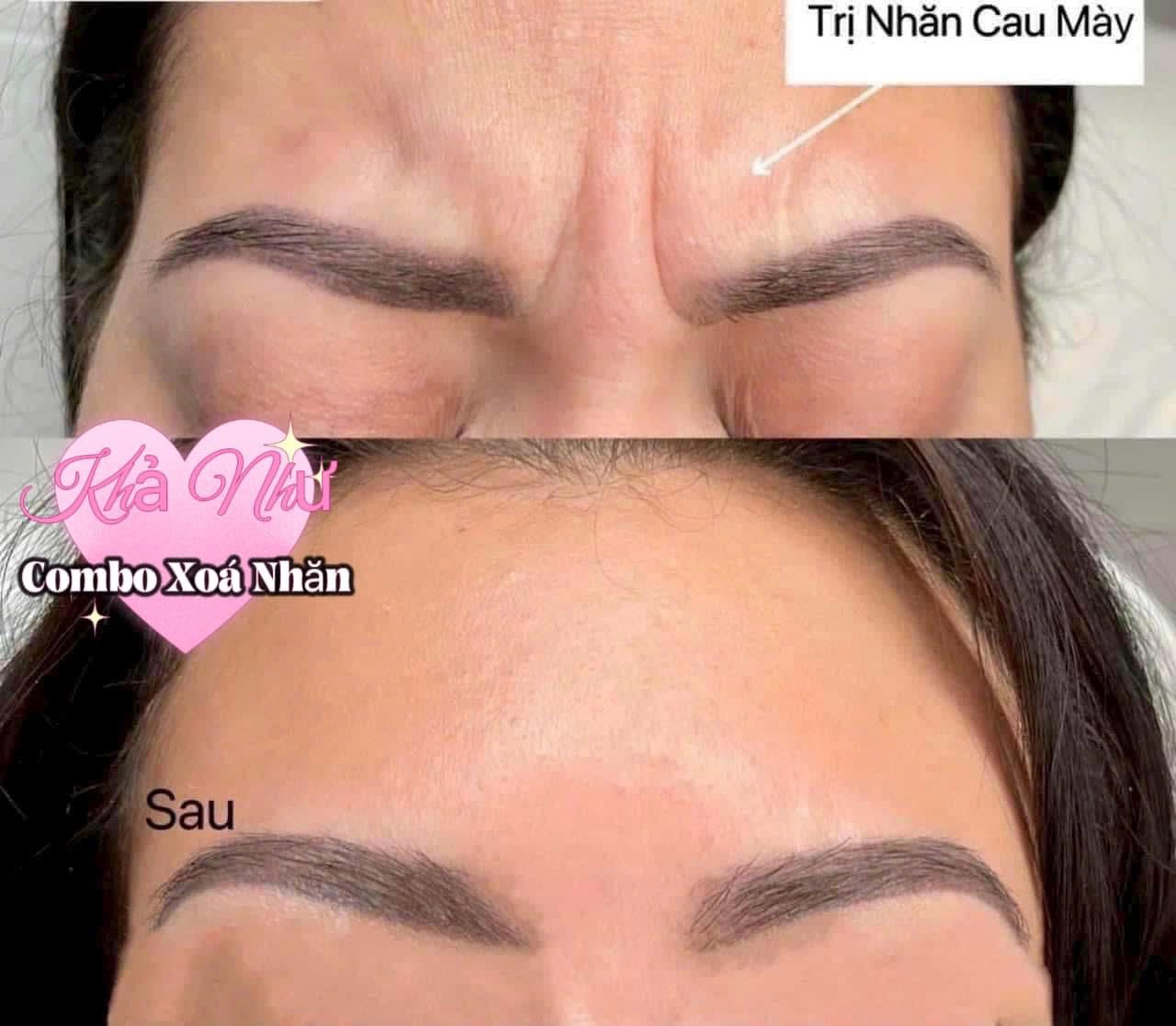 Xóa nhăn - nâng cơ chảy xệ