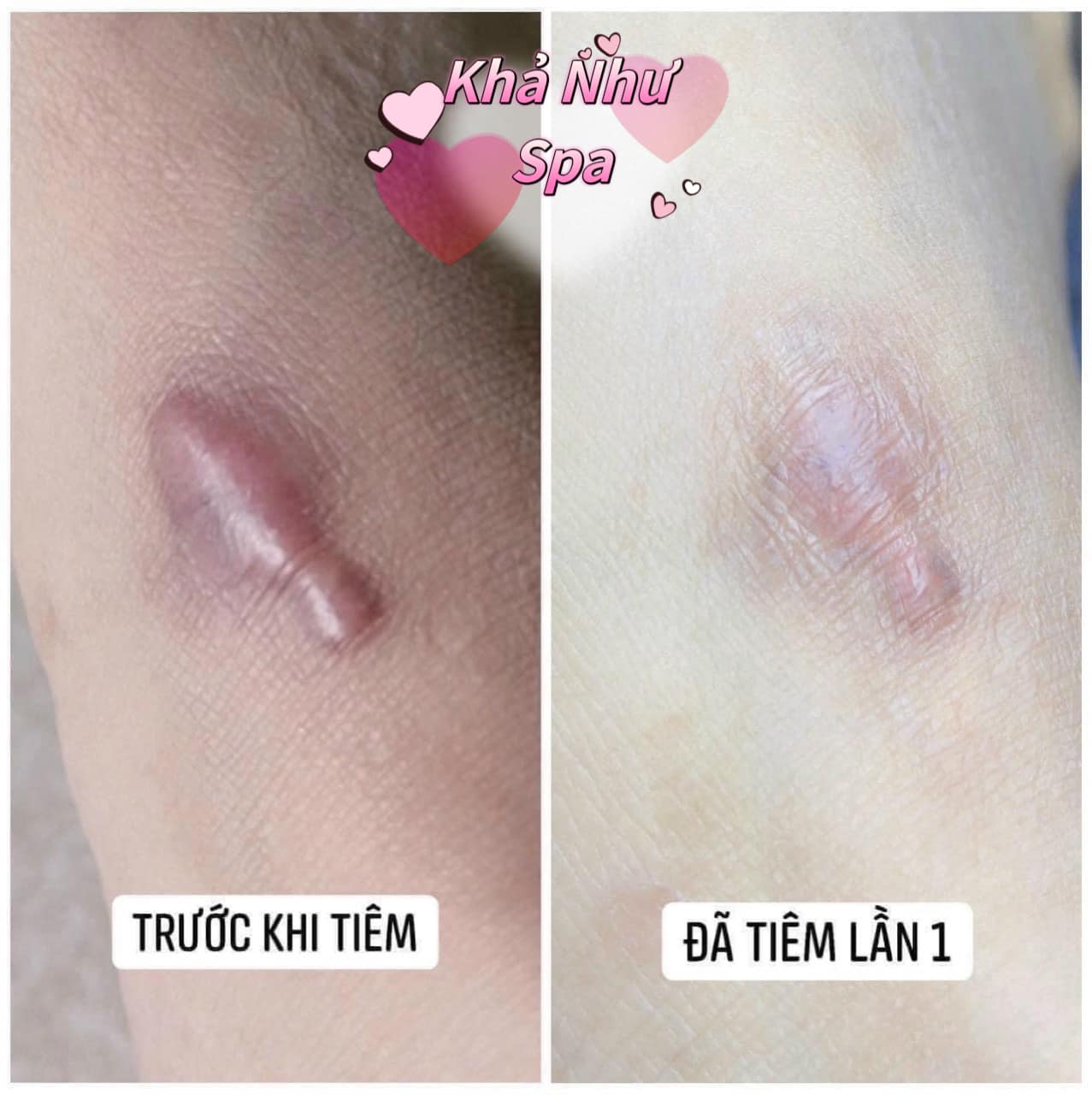 Điều trị sẹo