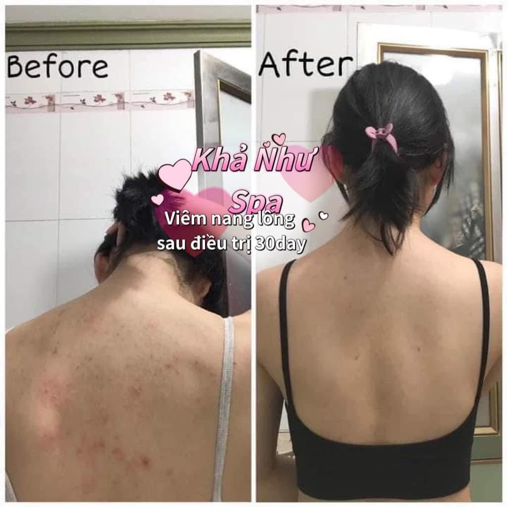 Điều trị viêm nang lông