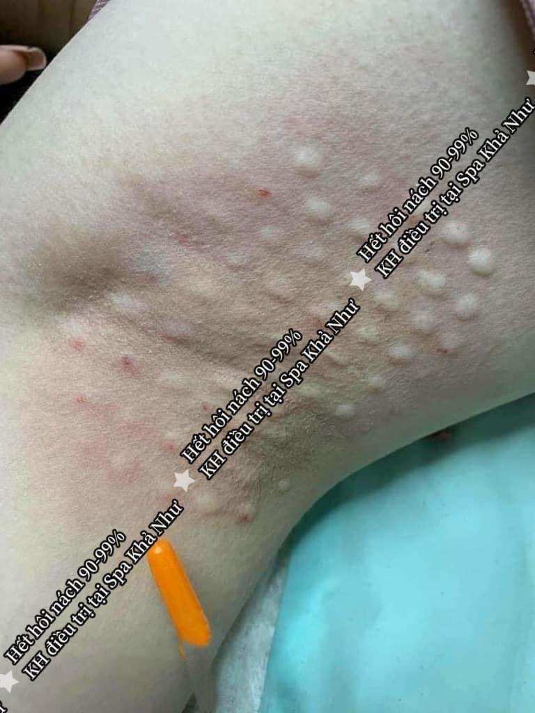 Điều trị hôi nách